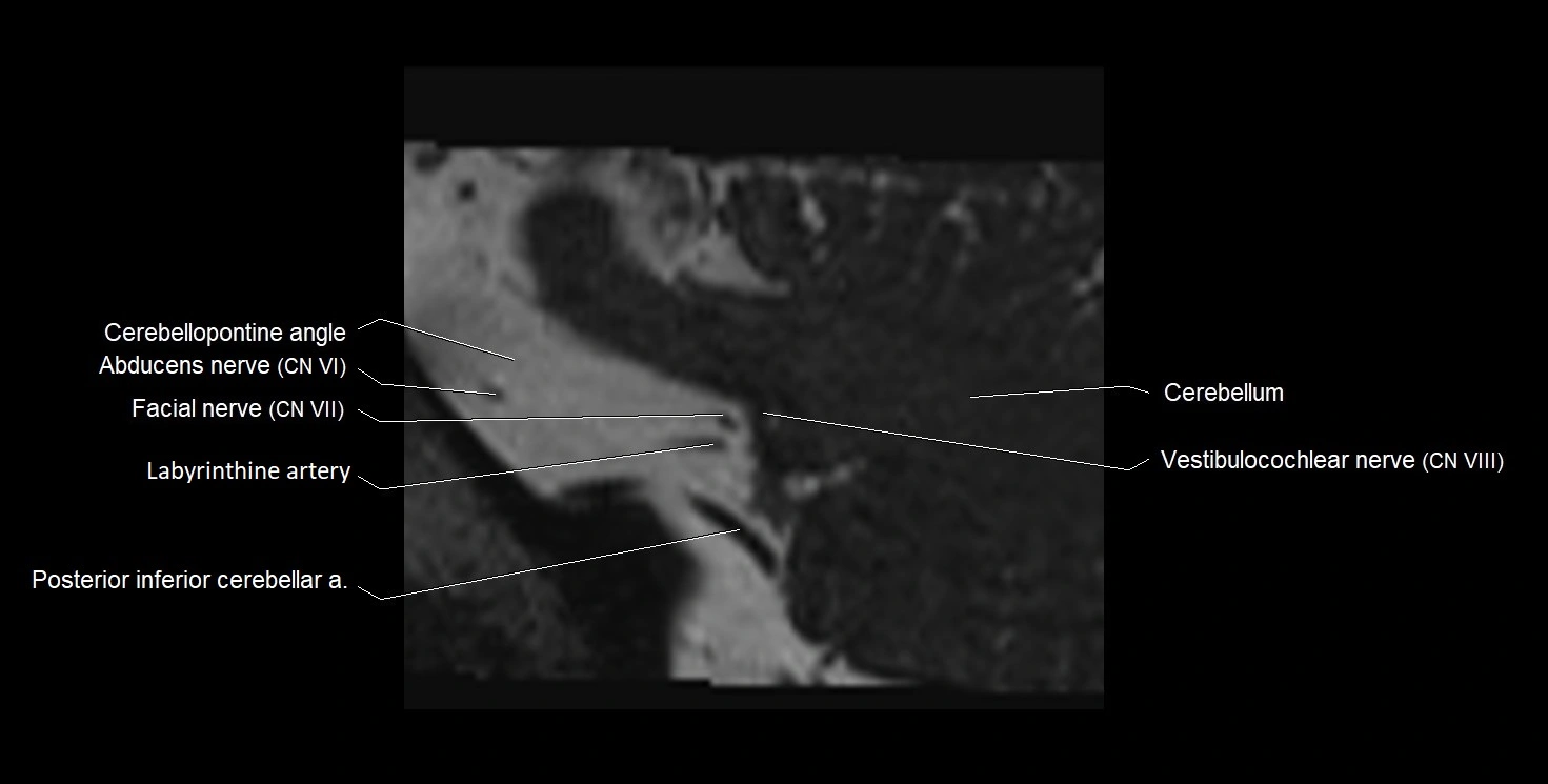 Internal auditory meatus (IAM) 3T sagittal cross sectional anatomy image 44.webp